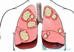 �ΰ���ת�Ʒ����Ƕ෢�Էΰ���ת�������Ҫ�����ֶ�