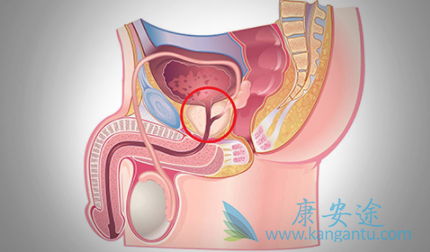 前列腺癌症 前列腺癌症