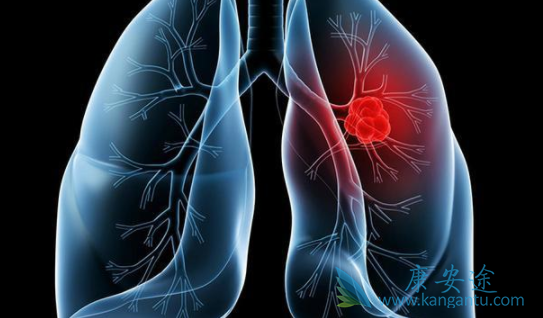 晚期肺癌 晚期肺癌
