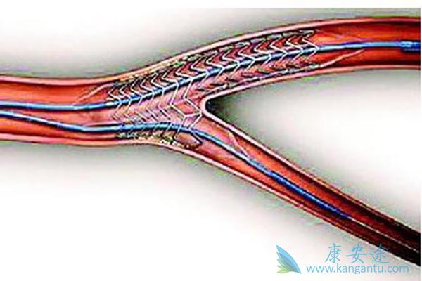 心脏支架 心脏支架