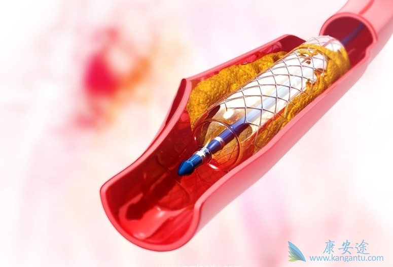 心脏支架 心脏支架