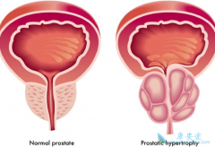 ��������(Cometriq)��Ϊת����ǰ���ٰ������洦��