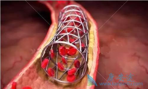 心脏支架 心脏支架