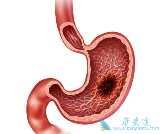 胃癌能活多久 胃癌能活多久