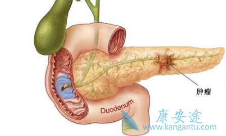 胰腺癌的治疗 胰腺癌的治疗