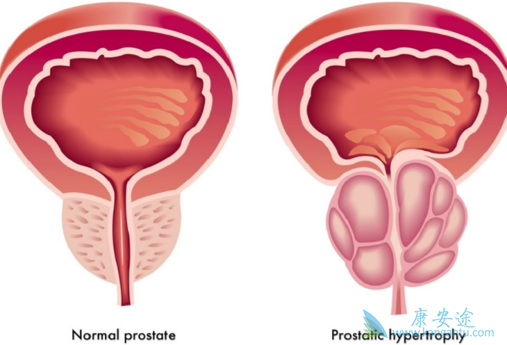 前列腺癌能活多久 前列腺癌能活多久