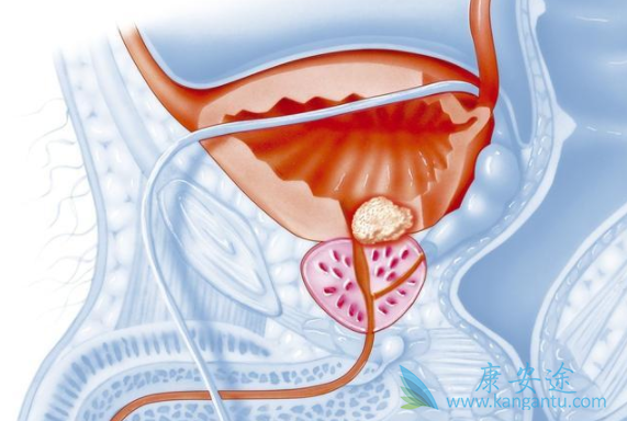前列腺癌治疗 前列腺癌治疗