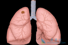 ���ڷΰ����߷��ð������ᷢ����Ѫ������Ҫͣҩ��