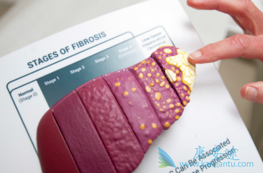 丙肝会传染吗 丙肝会传染吗