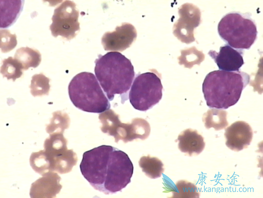 套细胞淋巴瘤 套细胞淋巴瘤