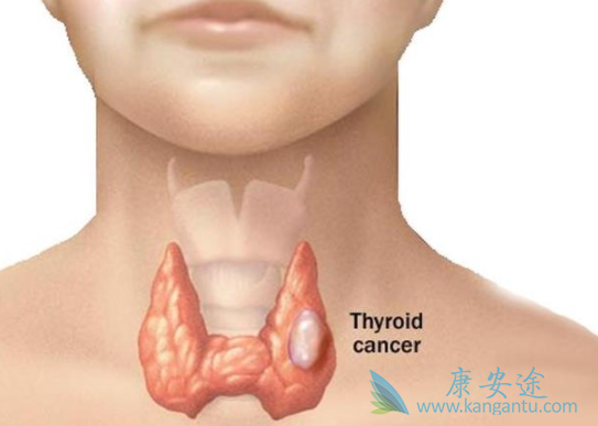 甲状腺癌症 甲状腺癌症