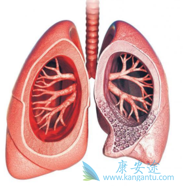 特发性肺纤维化 特发性肺纤维化