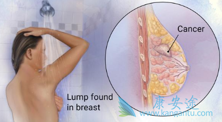 三阴性乳腺癌 三阴性乳腺癌