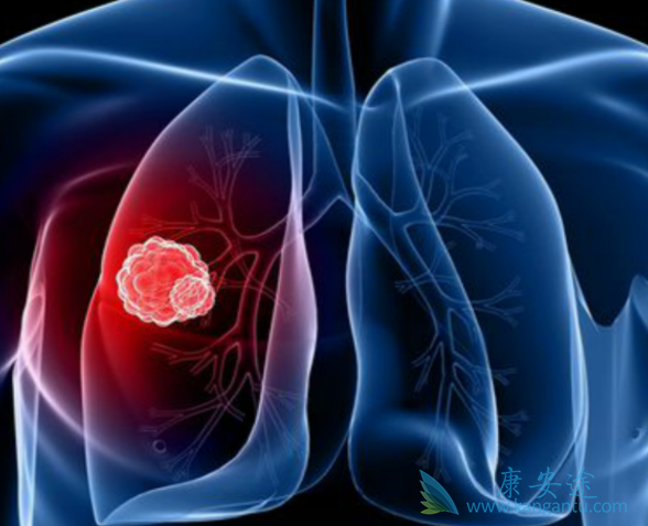 晚期肺癌 晚期肺癌