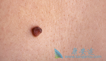 黑色素瘤 黑色素瘤