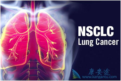 非小细胞肺癌 非小细胞肺癌