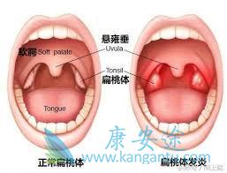扁桃体癌 扁桃体癌