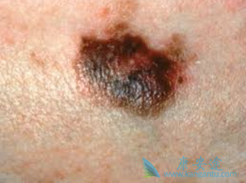 黑色素瘤 黑色素瘤