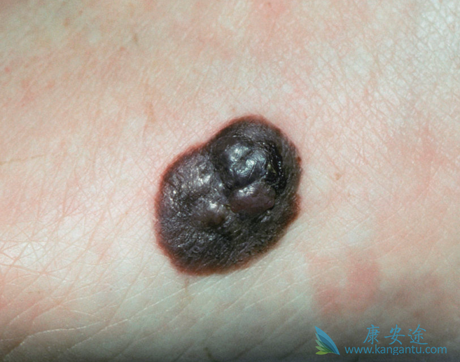 黑色素瘤 黑色素瘤