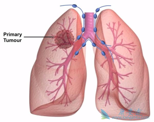 肺动脉高压 肺动脉高压