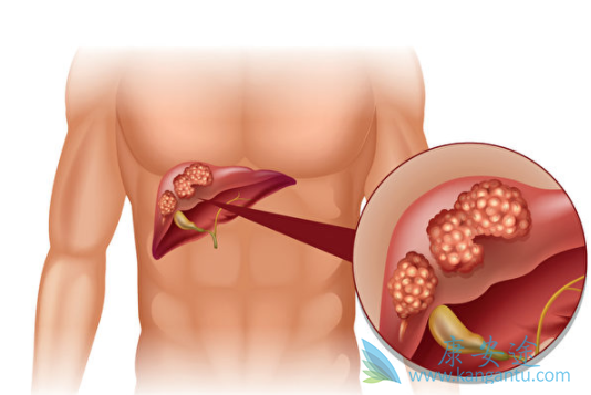 肝癌治疗 肝癌治疗