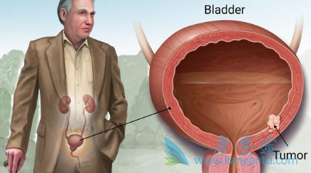癌症生存率 癌症生存率