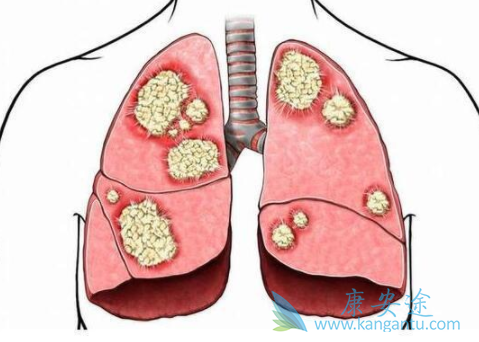 肺癌化疗 肺癌化疗
