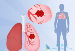 ���������зΰ����߶����еķΰ�������ǰ֢״