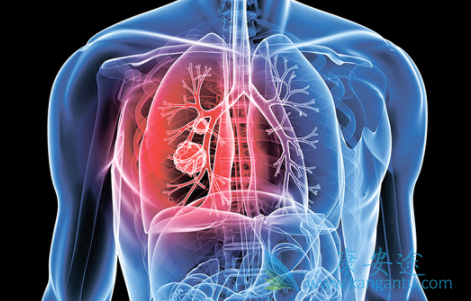 肺癌复发症状 肺癌复发症状