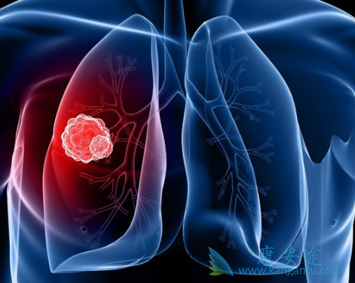 肺癌晚期有什么症状 肺癌晚期有什么症状