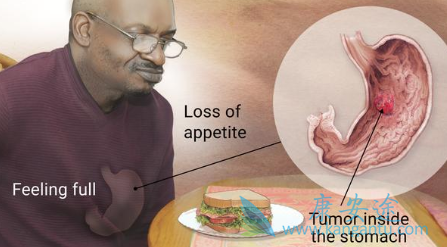 胃癌患者 胃癌患者