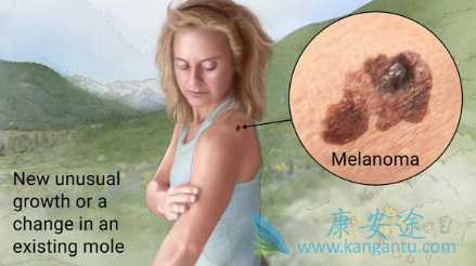 Binimetinib Binimetinib