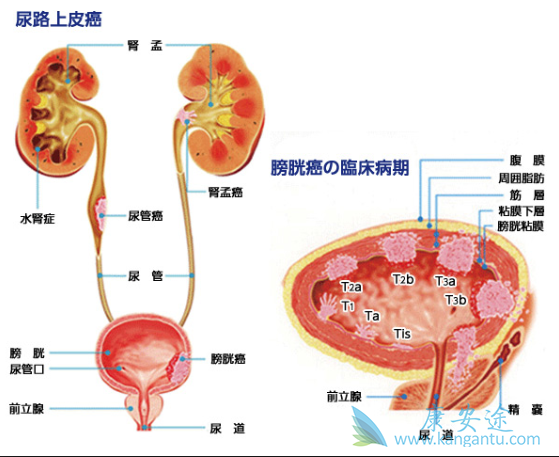 晚期尿路上皮癌 晚期尿路上皮癌