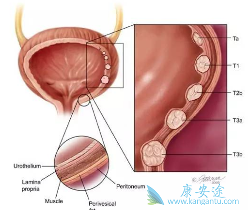 FGFR3突变 FGFR3突变