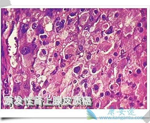 肾上腺皮质癌 肾上腺皮质癌