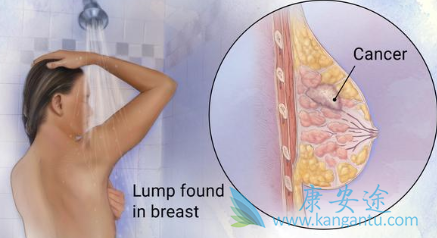 三阴性乳腺癌 三阴性乳腺癌