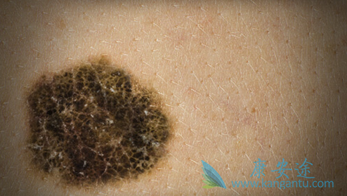 什么是黑色素瘤 什么是黑色素瘤