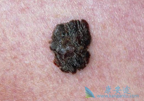 什么是黑色素瘤 什么是黑色素瘤