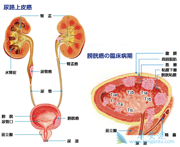 晚期尿路上皮癌 晚期尿路上皮癌