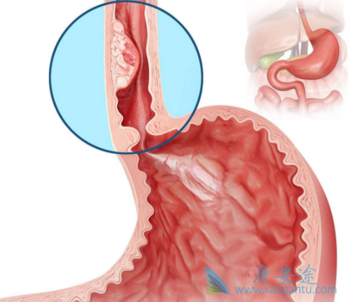 安罗替尼 安罗替尼
