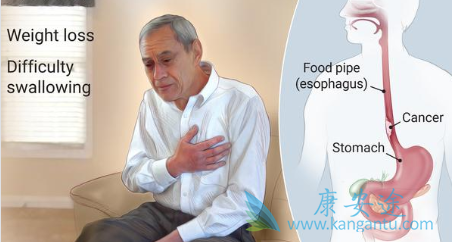 食道癌 食道癌