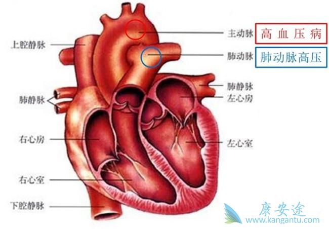 肺动脉高压 肺动脉高压