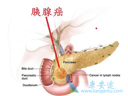 胰腺癌 胰腺癌