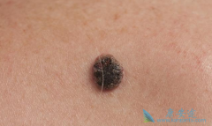 ��ɫ���������ת�Ƶ�֢״����Щ����ת�Ƹ��ʴ󲻴�