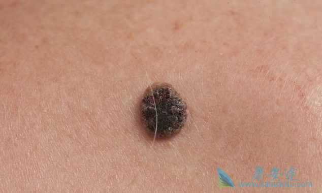 黑色素瘤 黑色素瘤