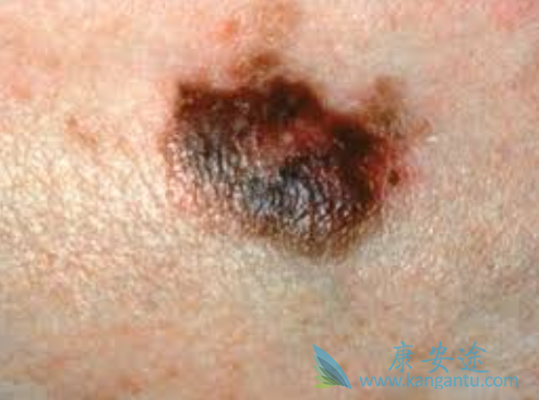 黑色素瘤 黑色素瘤