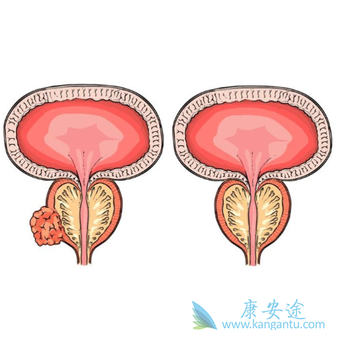 前列腺癌 前列腺癌
