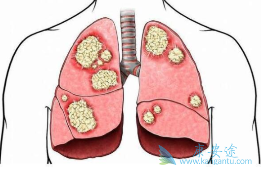 非小细胞肺癌 非小细胞肺癌