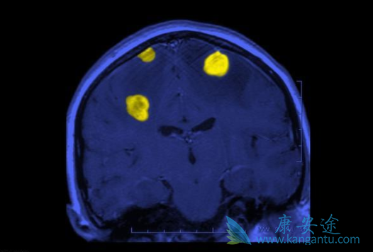 白质脑病 白质脑病