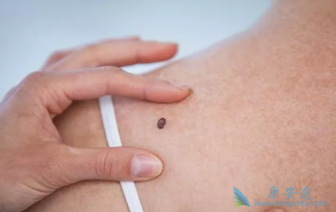 黑色素瘤 黑色素瘤